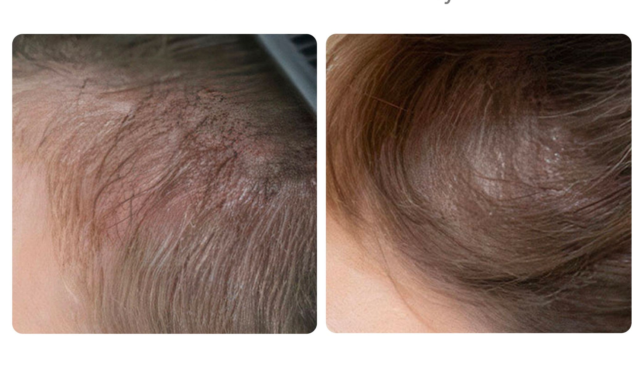 Hair Restoration with Exosomes