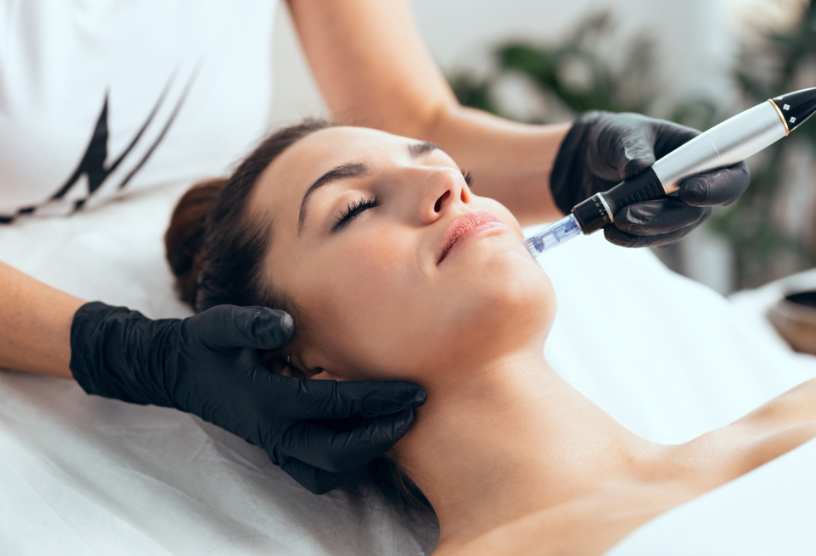 Microneedling with Exosomes